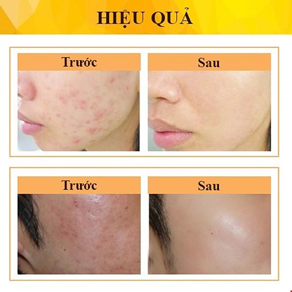 Dung dịch chấm mụn giảm sưng viêm Laura Sunshine Acnes Spot Treatment 30ml